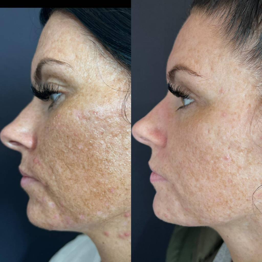 SkinPen Microneedling, skin clinic kilmarnock