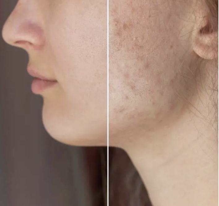 Clearer Skin at Every Age: Clinic22’s Holistic Approach to Acne Treatment